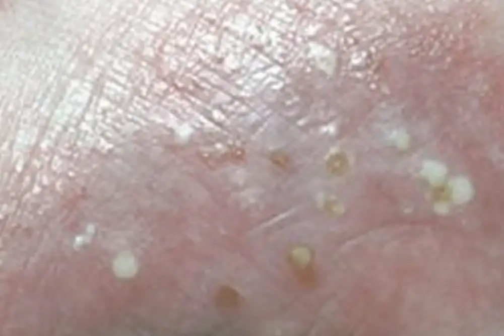 Pustular psoriasis