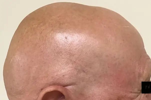 Alopecia universalis
