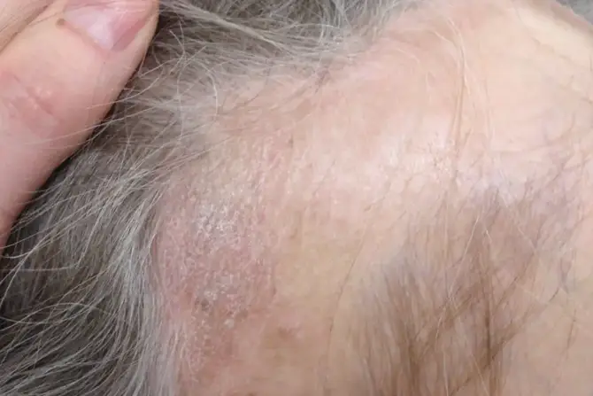 Seborrheic dermatitis