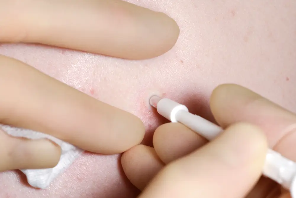 Skin biopsy procedure showing a punch biopsy being performed on a patient's skin