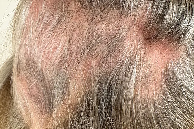 Alopecia areata