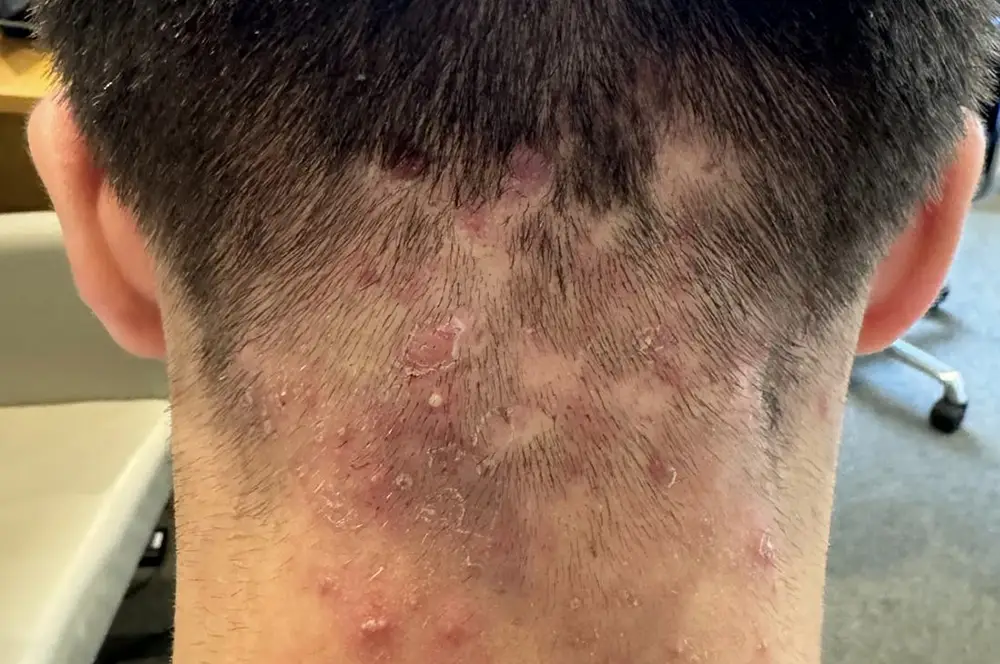 Gram-negative folliculitis on neck and scalp