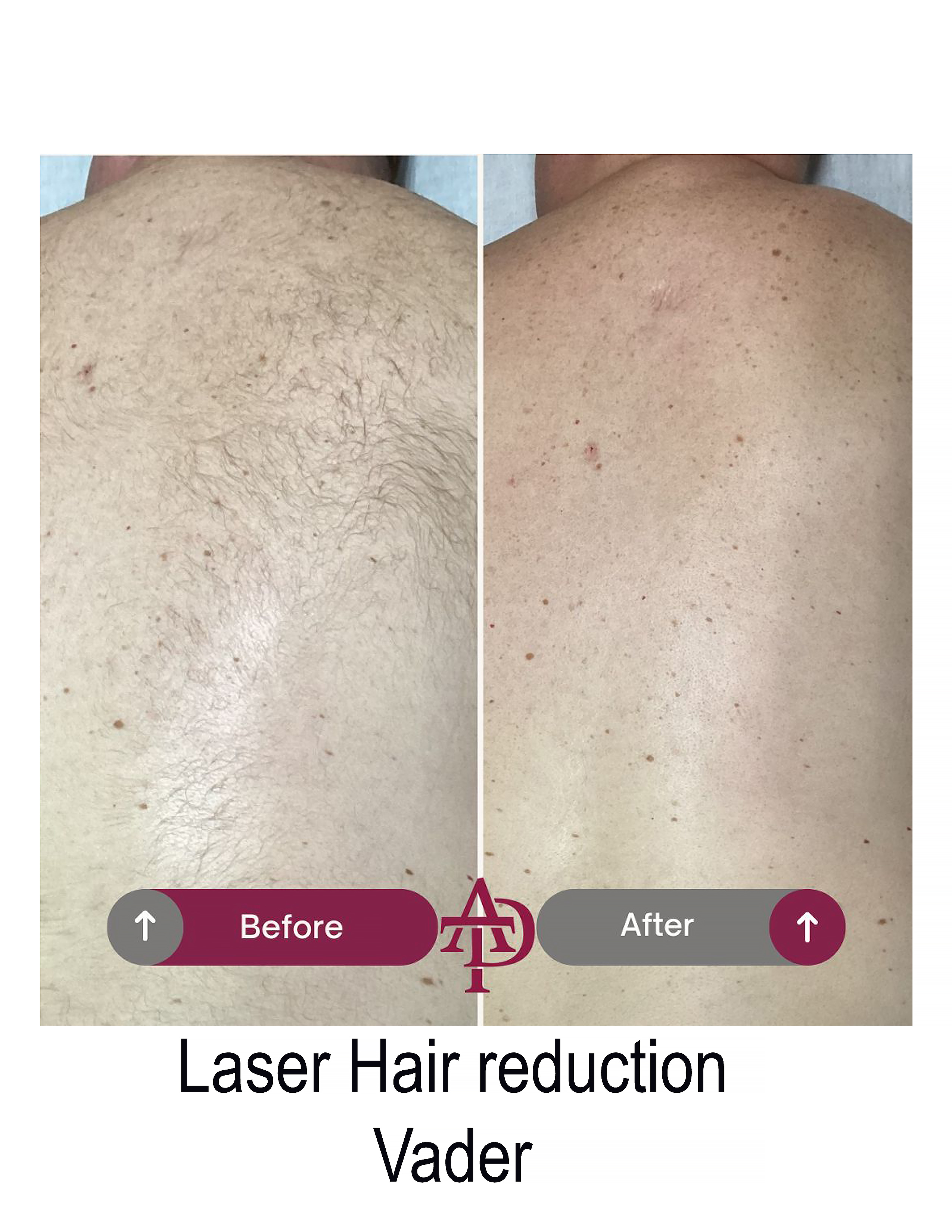Laser result 5
