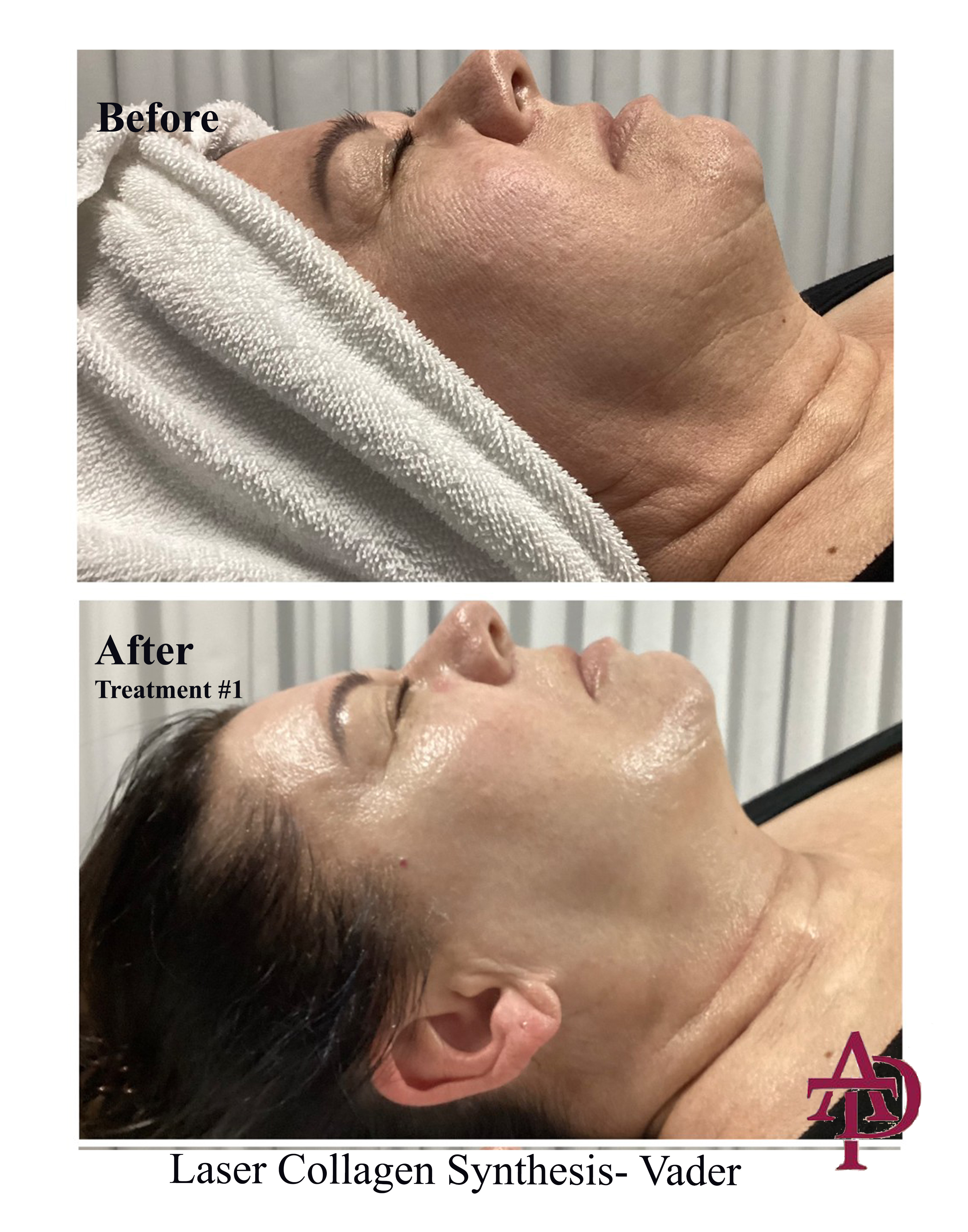 Laser result 2