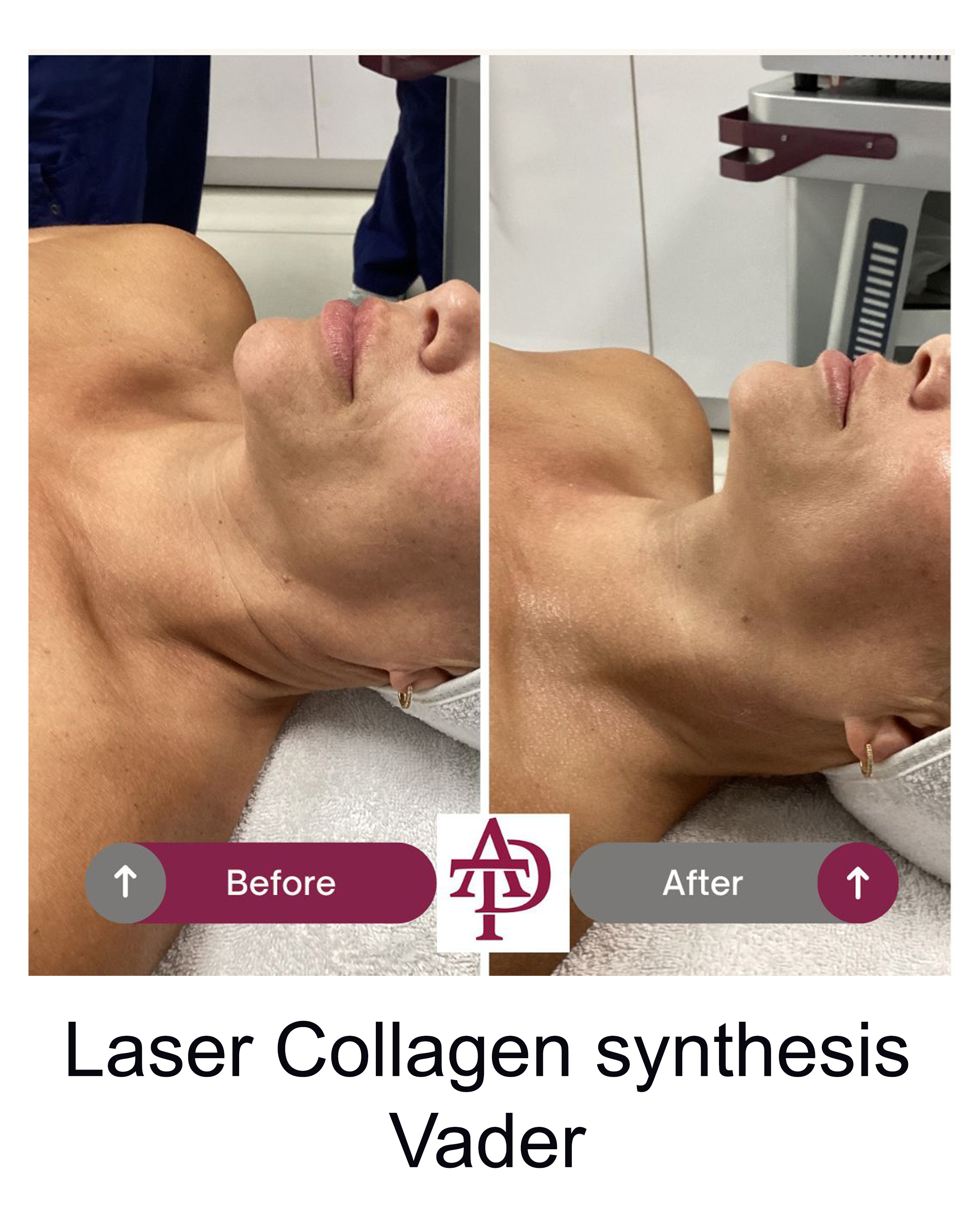 Laser result 1
