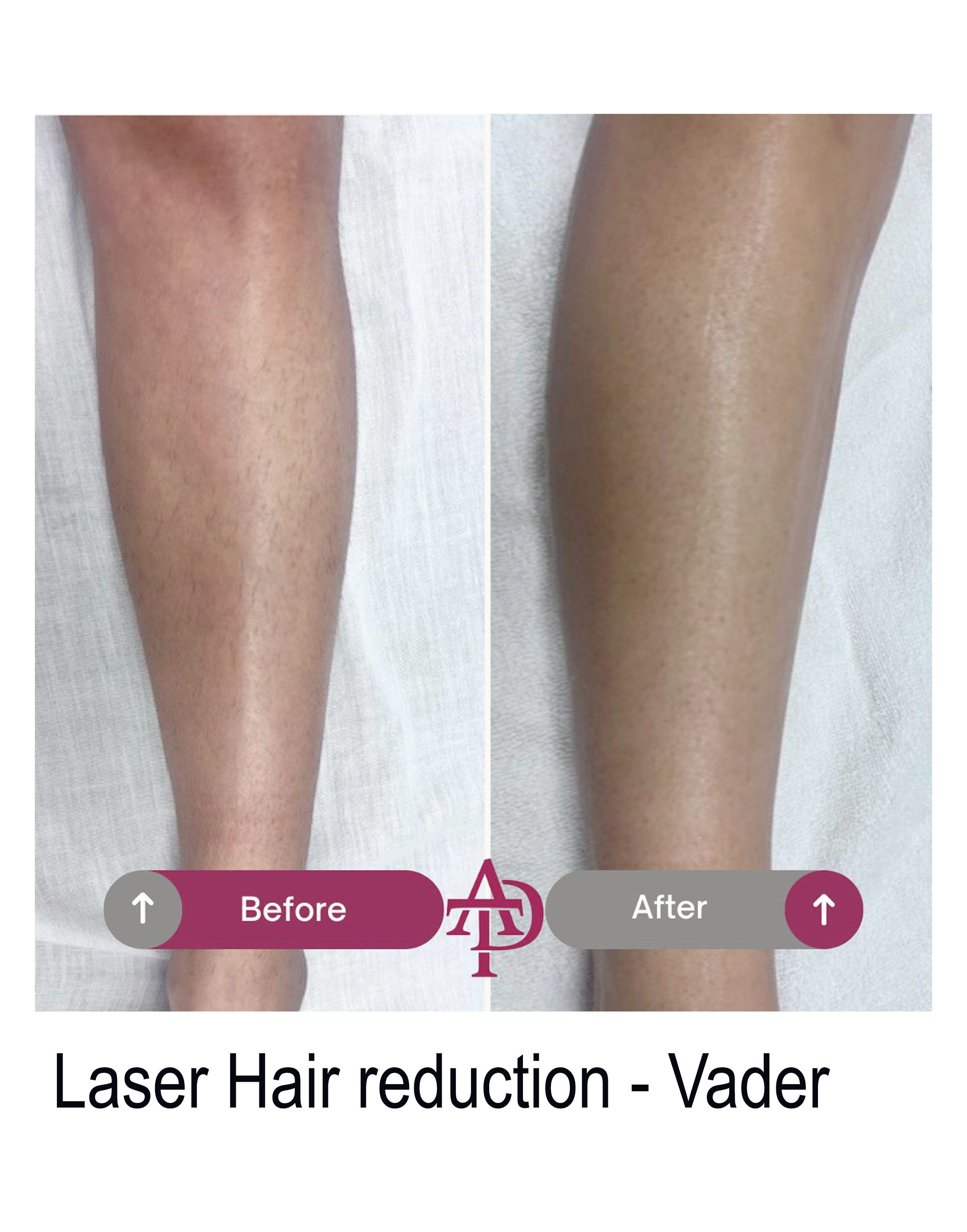 Laser result 4