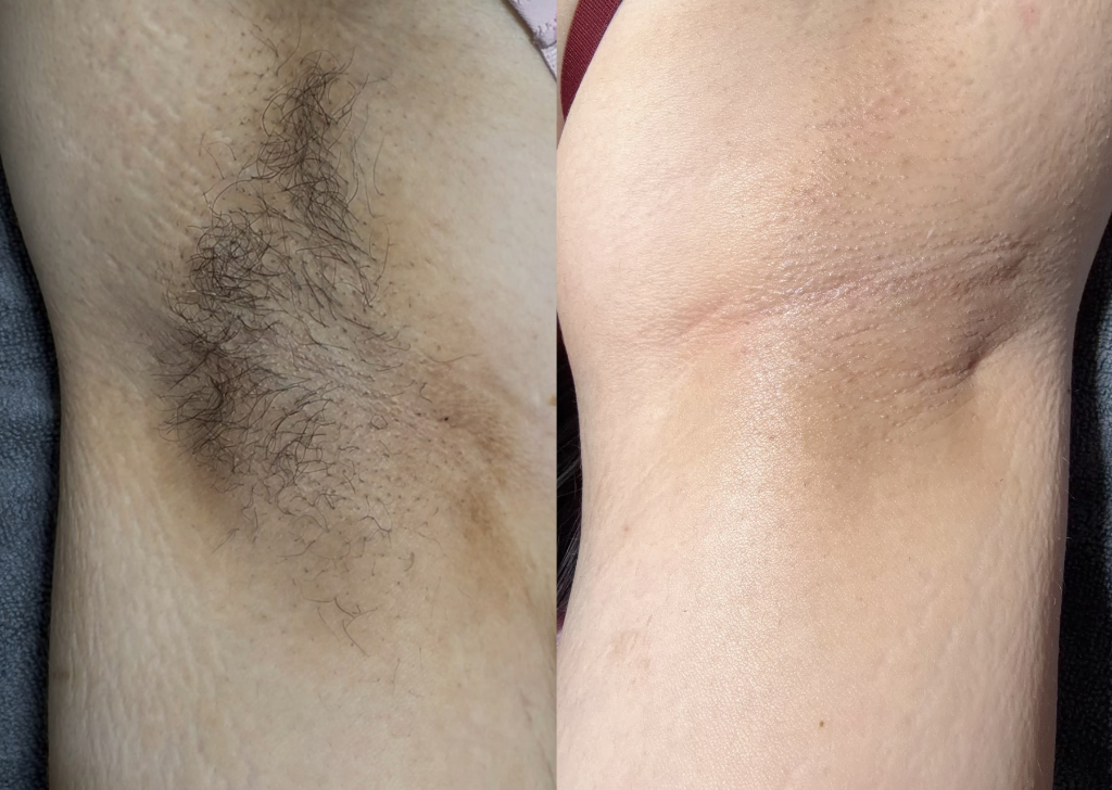 Laser result 6
