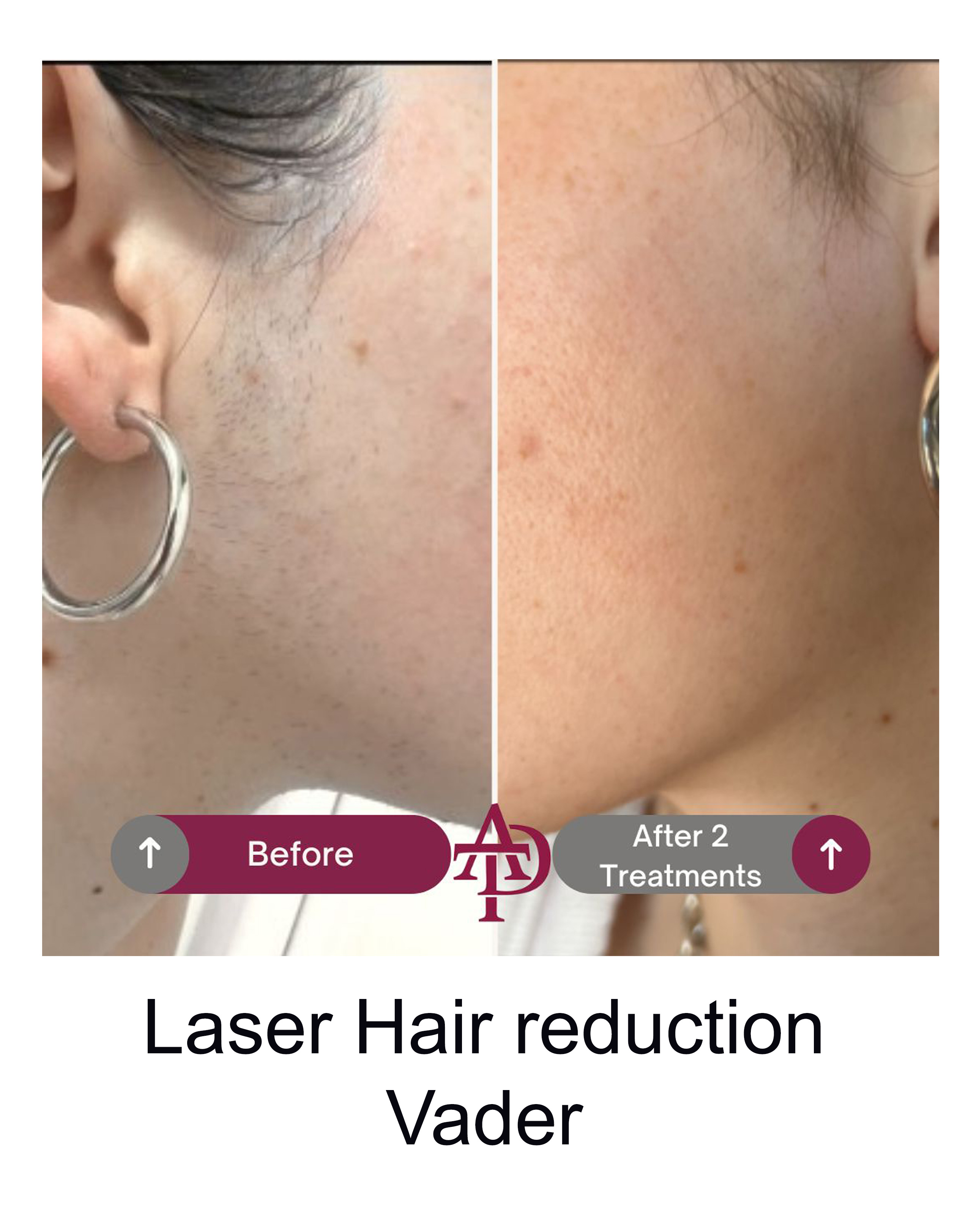 Laser result 3