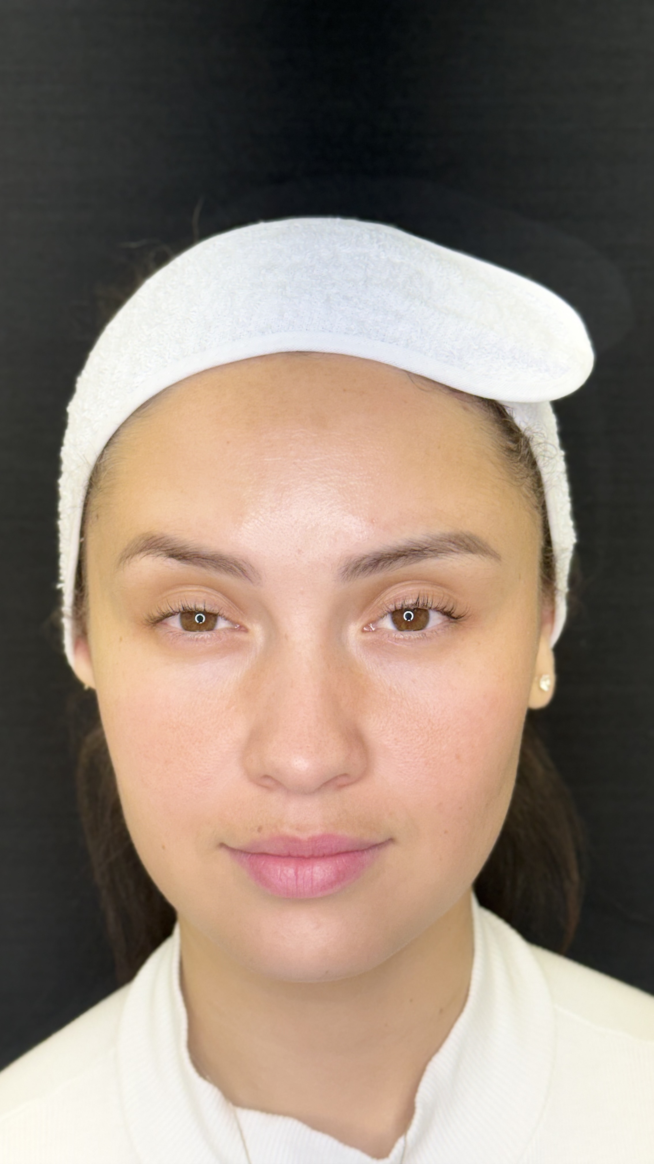 Botox — Toxina Botulínica