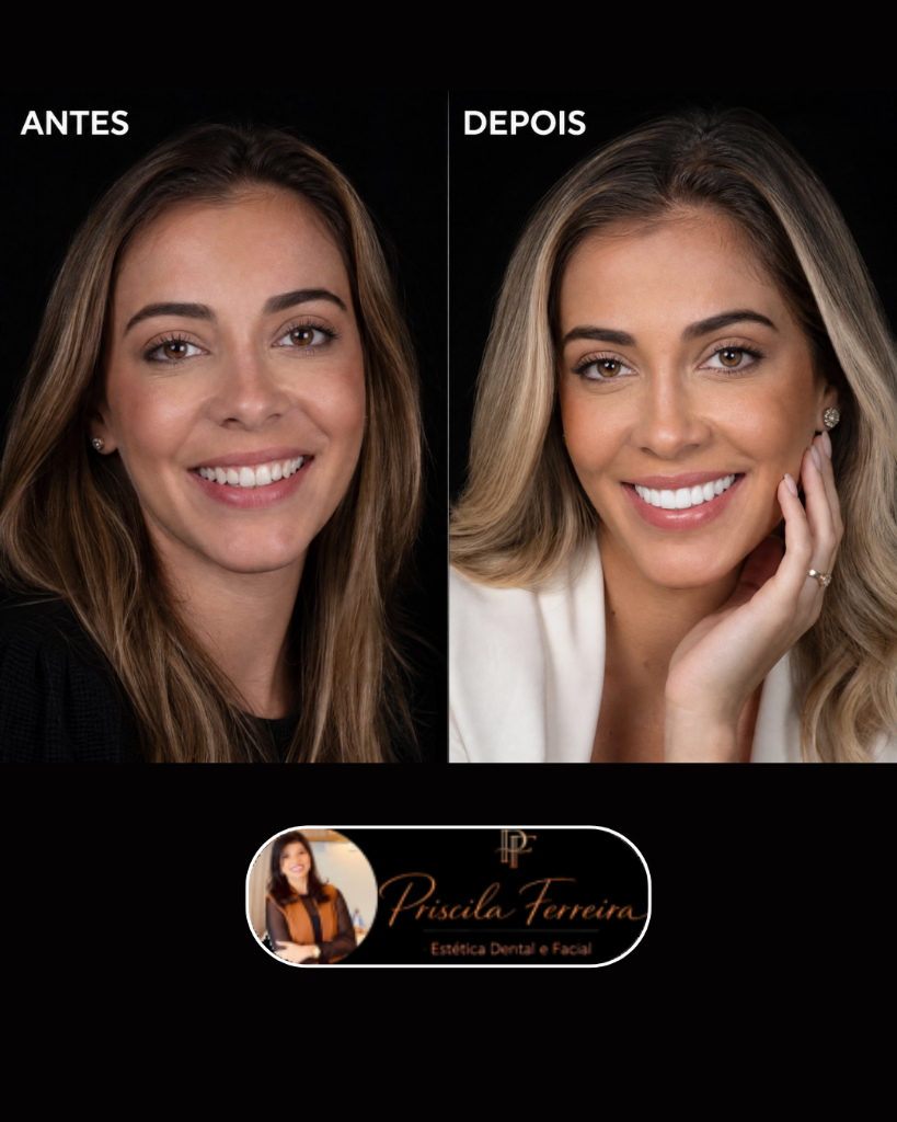 Facetas de Resina caso 8