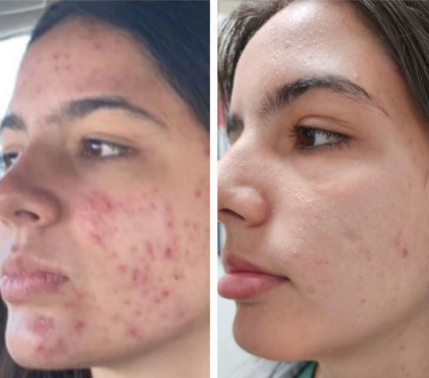 Facial Treatment