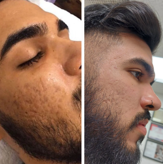 Skin Rejuvenation