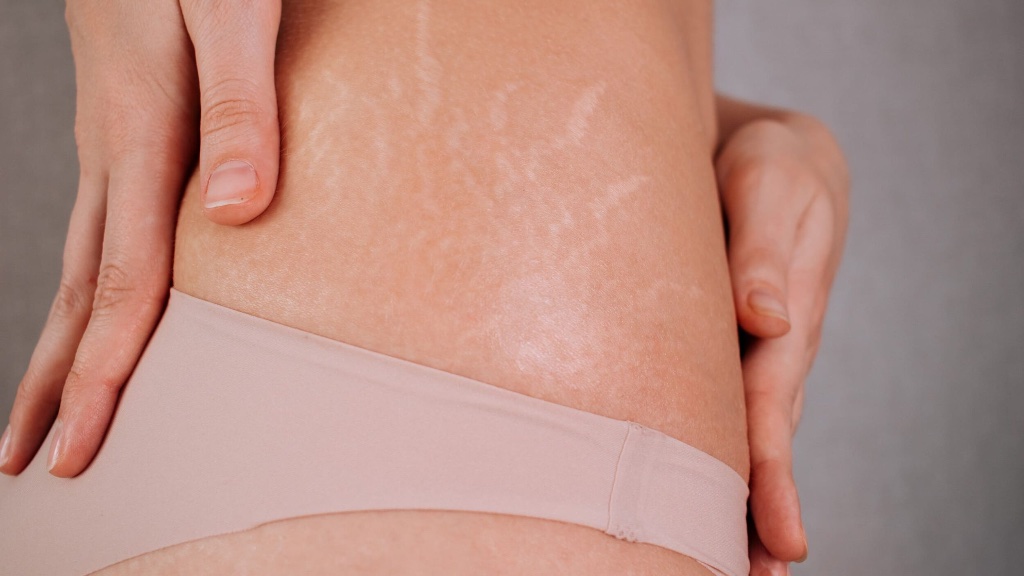 Stretch Mark Camouflage