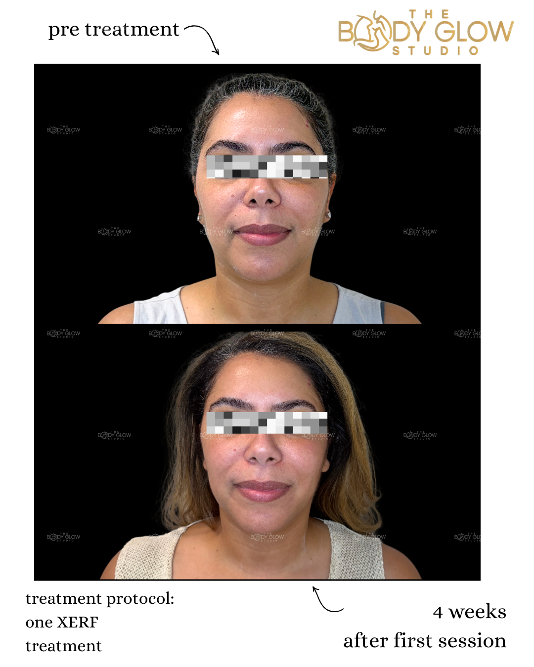XERF™ — Facial Contouring