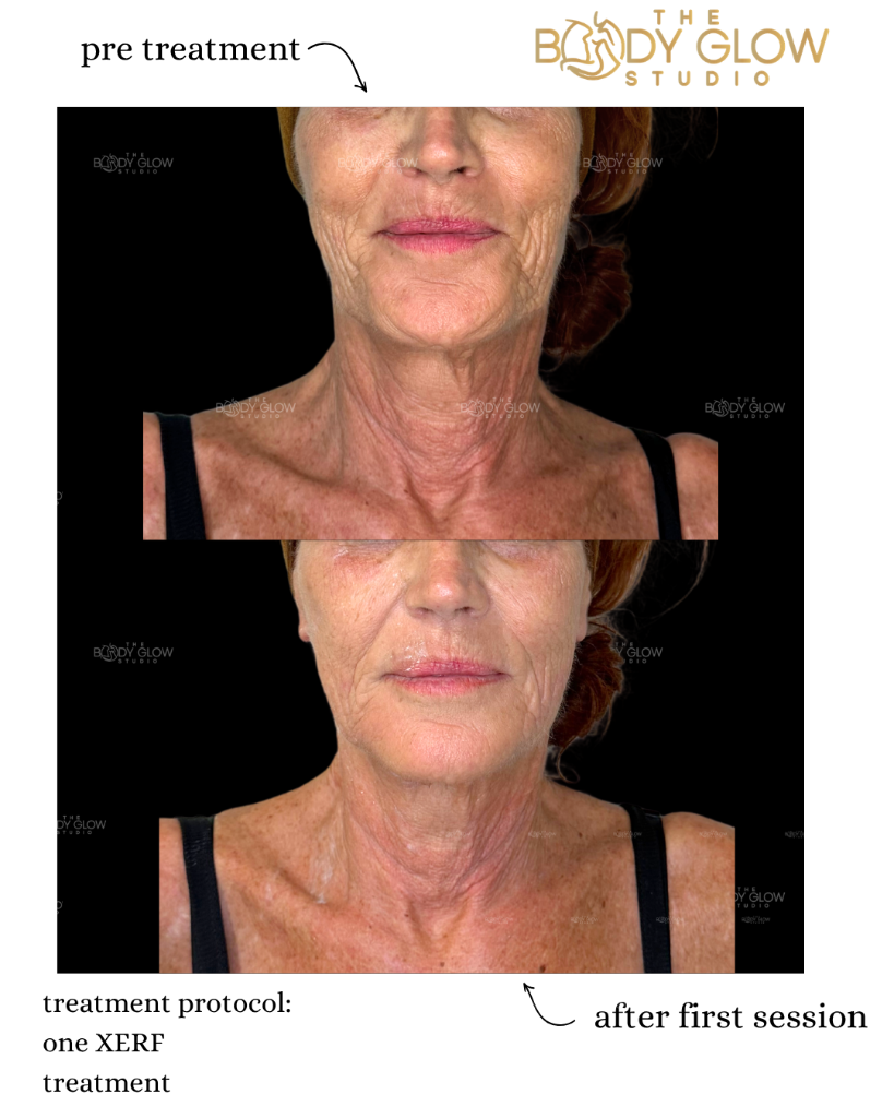 XERF™ — Neck & Jawline Contouring
