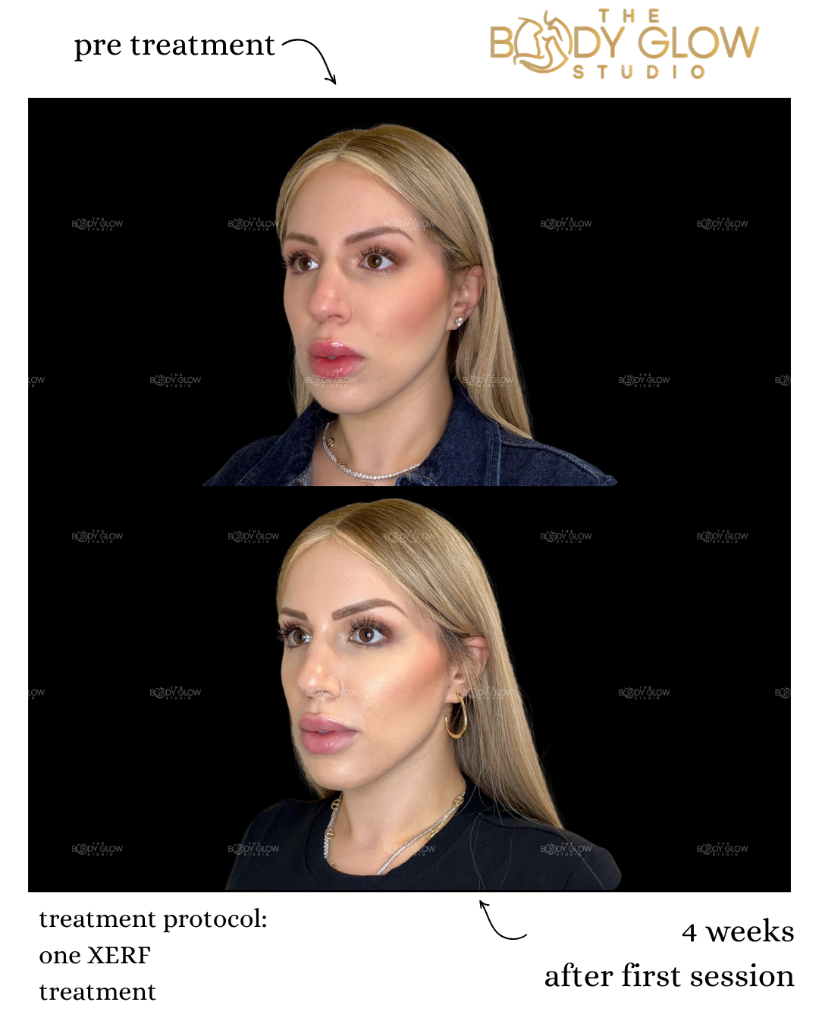 XERF™ — Facial Contouring