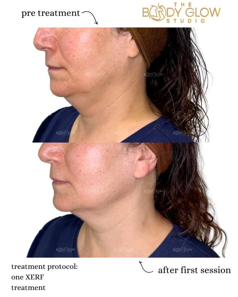 XERF™ — Submental & Jawline Contouring