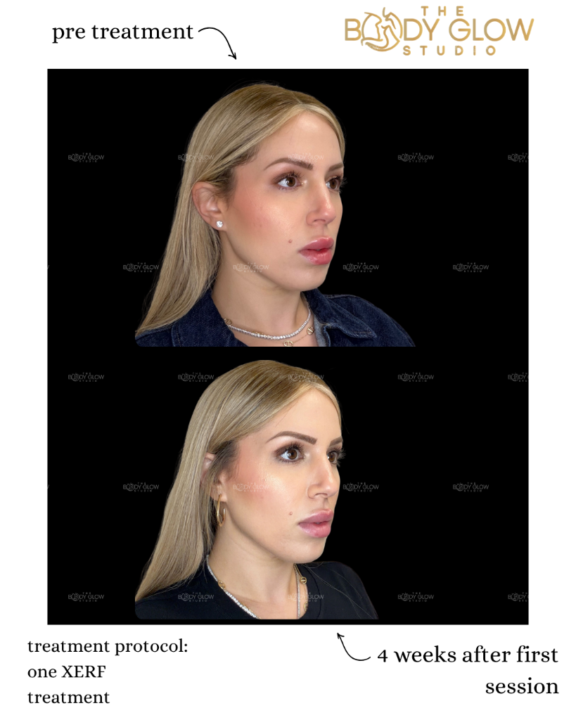 XERF™ — Profile Contouring