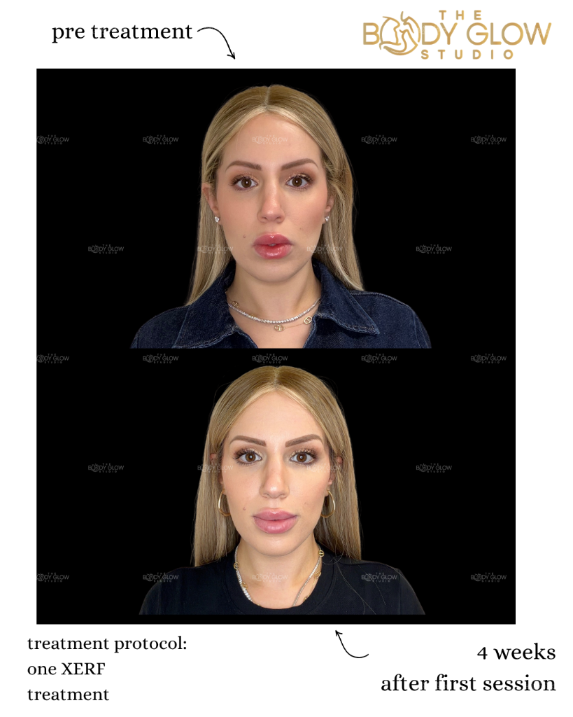 XERF™ — Jawline Contouring