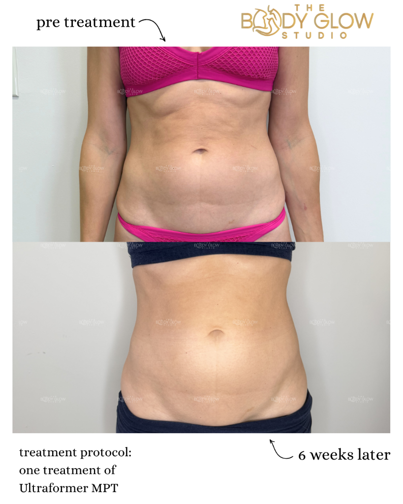 XERF Treatment — Face & Eye Area