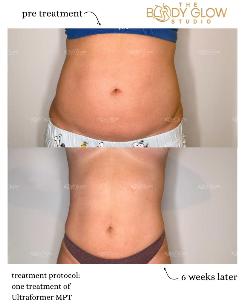 Ultraformer MPT — Abdomen