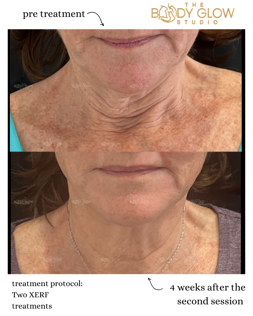 XERF™ — Neck Tightening