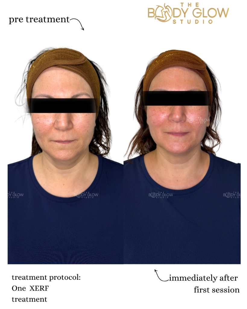 XERF™ — Facial Contouring