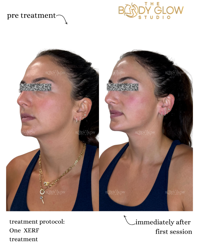 XERF™ — Facial Contouring