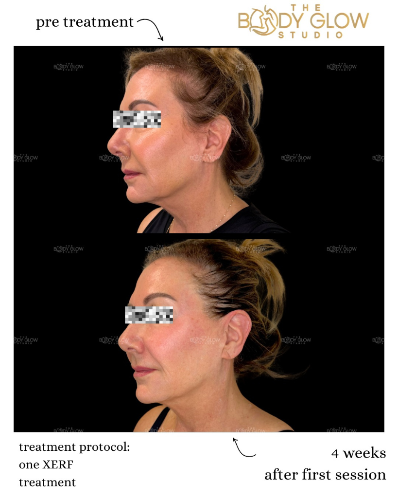 XERF™ — Profile Contouring