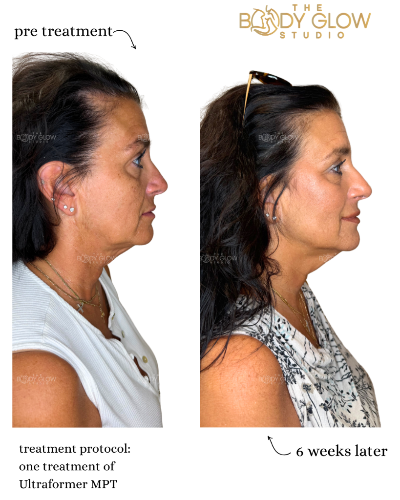 Ultraformer MPT — Face & Neck Lift