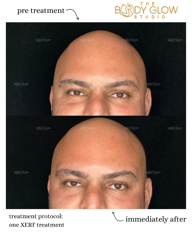 Ultraformer MPT — Jawline & Neck