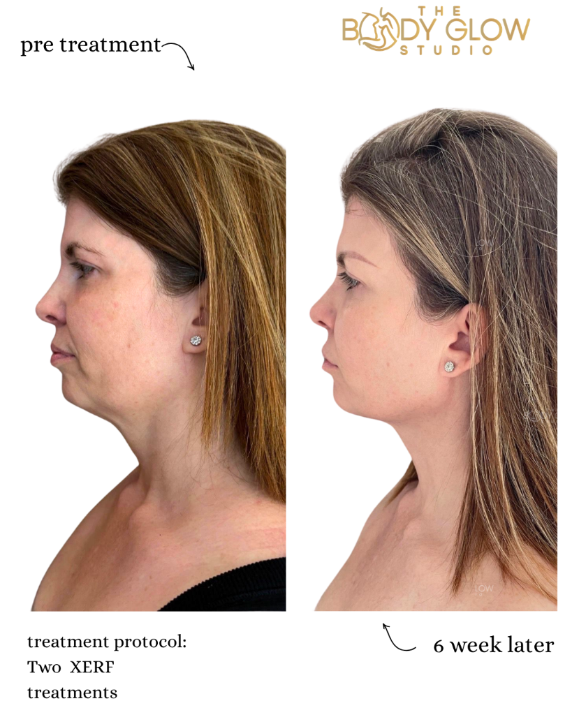 XERF™ — Face & Neck Lift