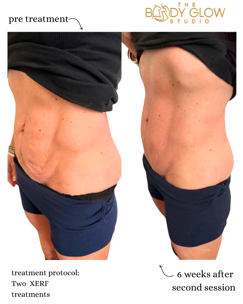 XERF™ — Abdomen & Side Contouring