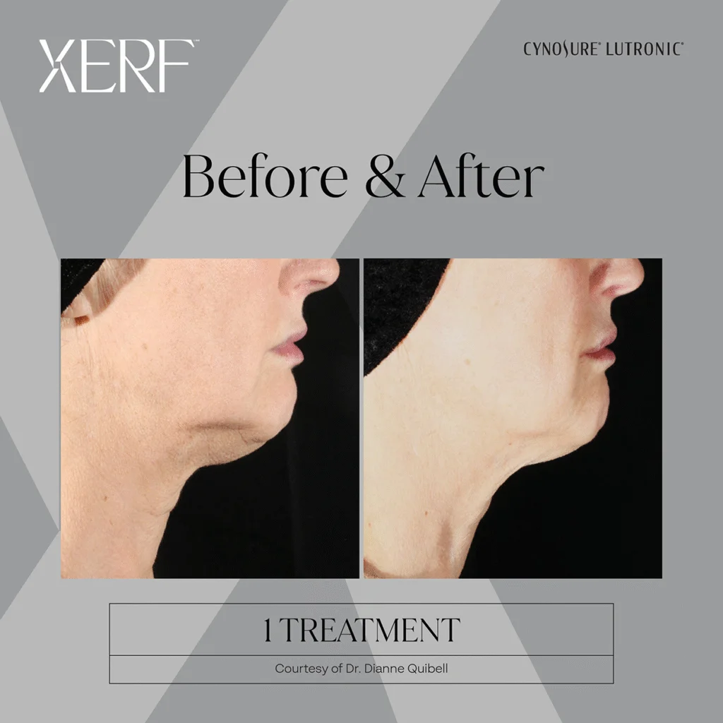 XERF treatment results