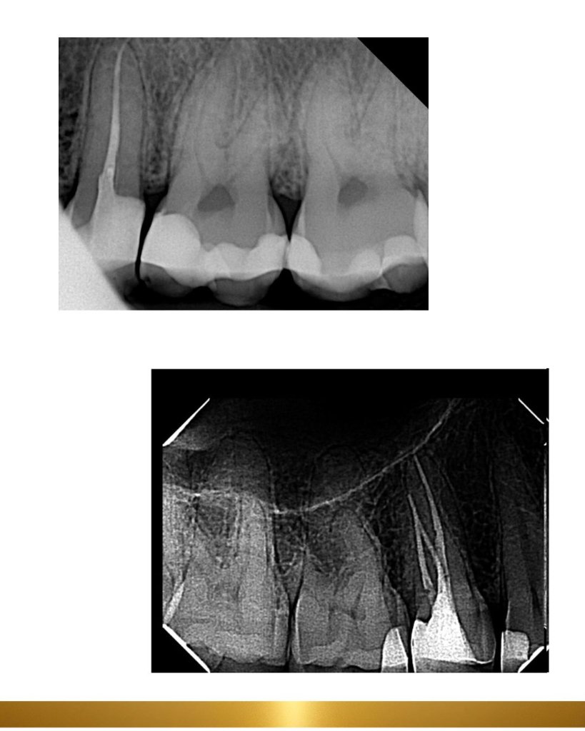 Before and after 17