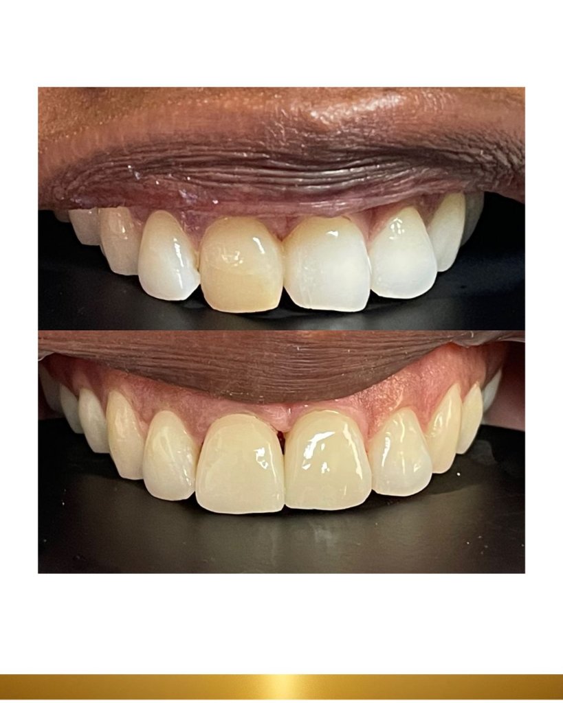 Before and after 15