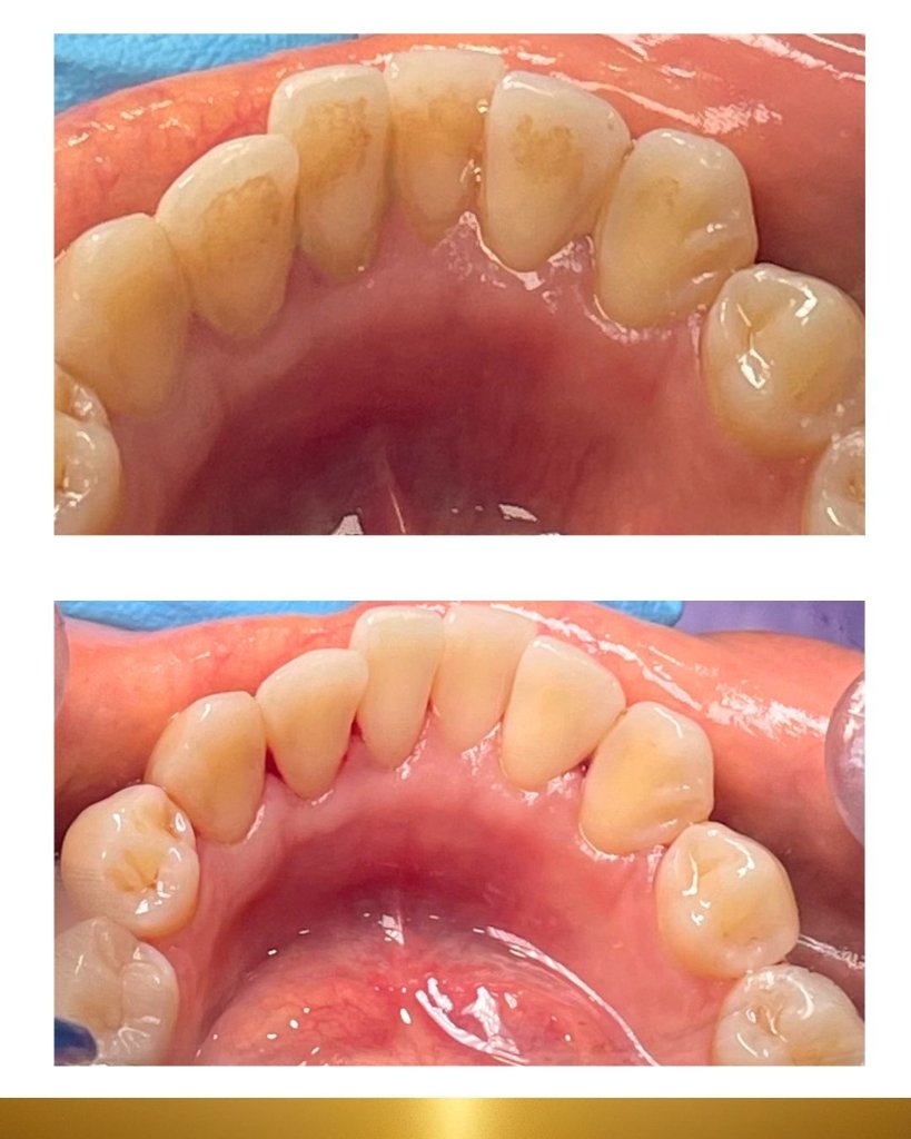 Before and after 2