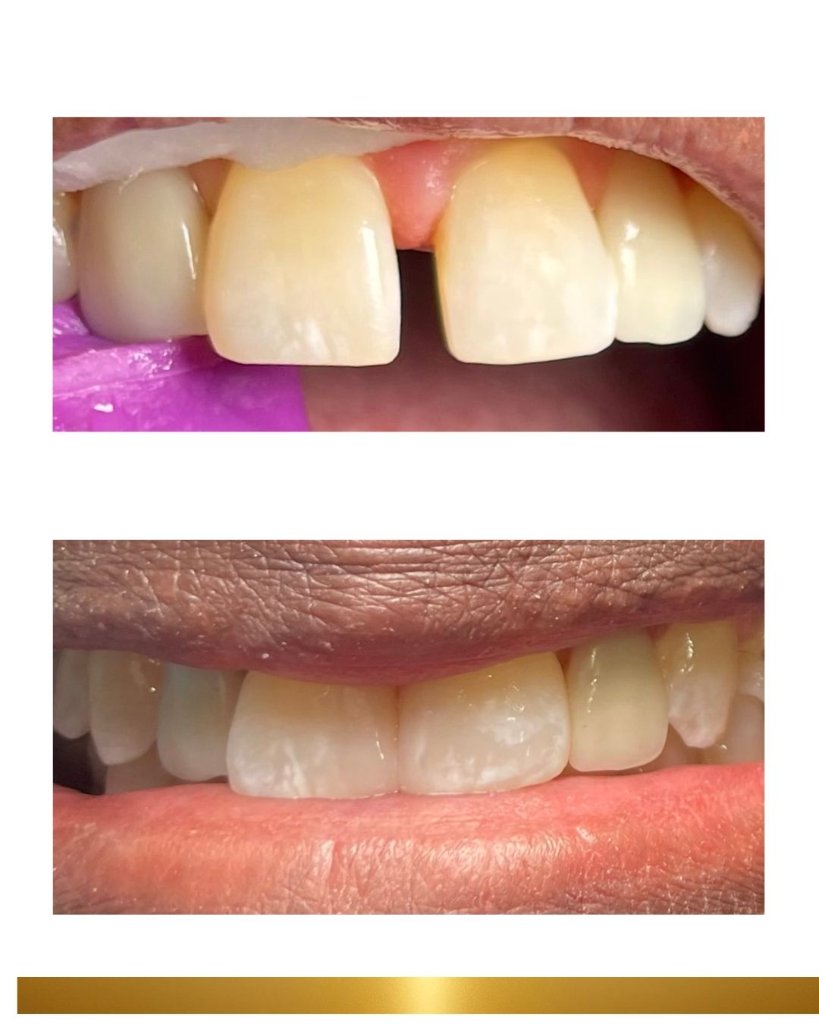 Before and after 4