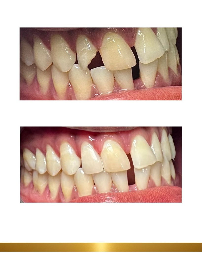 Before and after 20