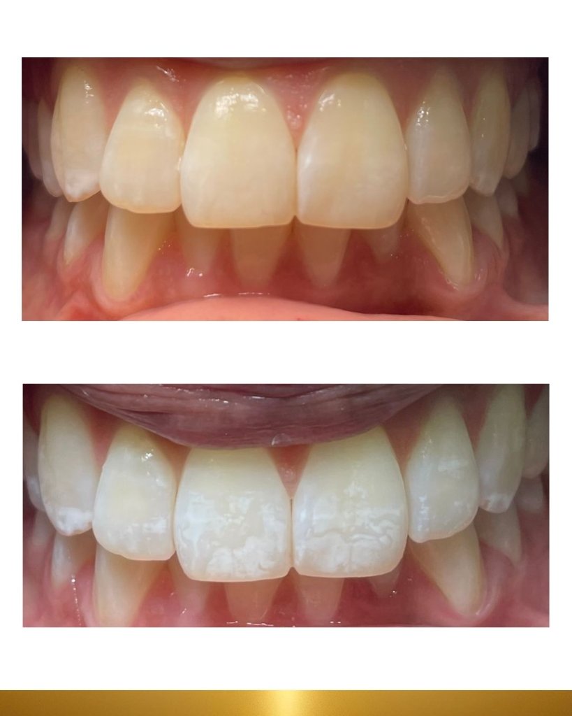 Before and after 5
