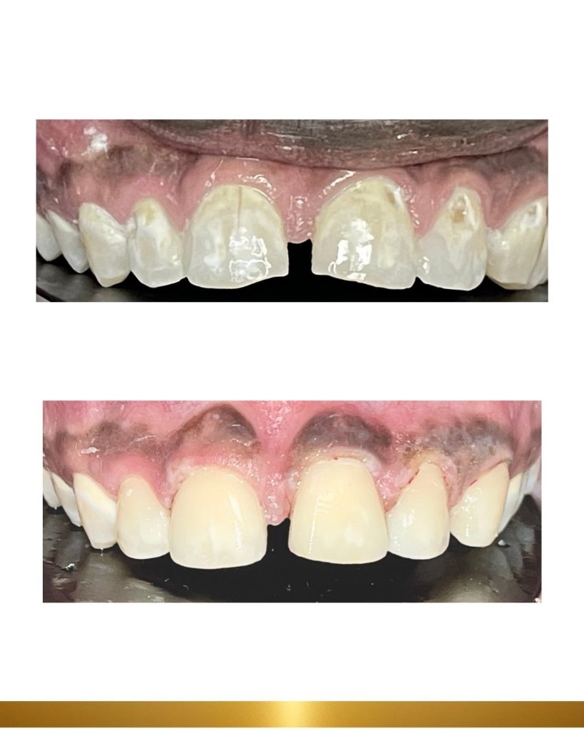 Before and after 14