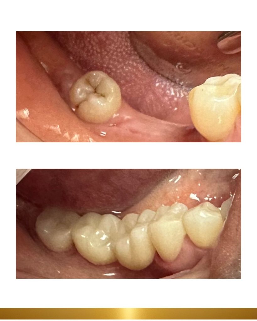 Before and after 11