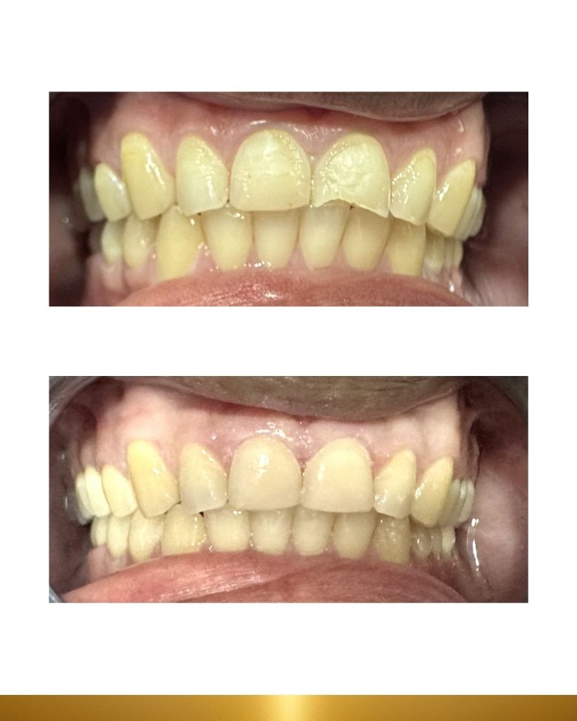Before and after 1