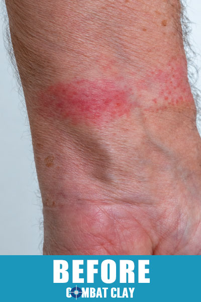 Skin rash on wrist before using Combat Clay Soothing Skin Spray