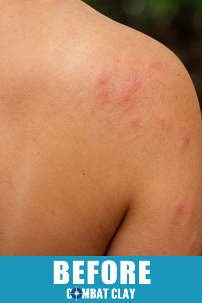 Allergic reaction rash on shoulder before using Combat Clay Soothing Skin Spray