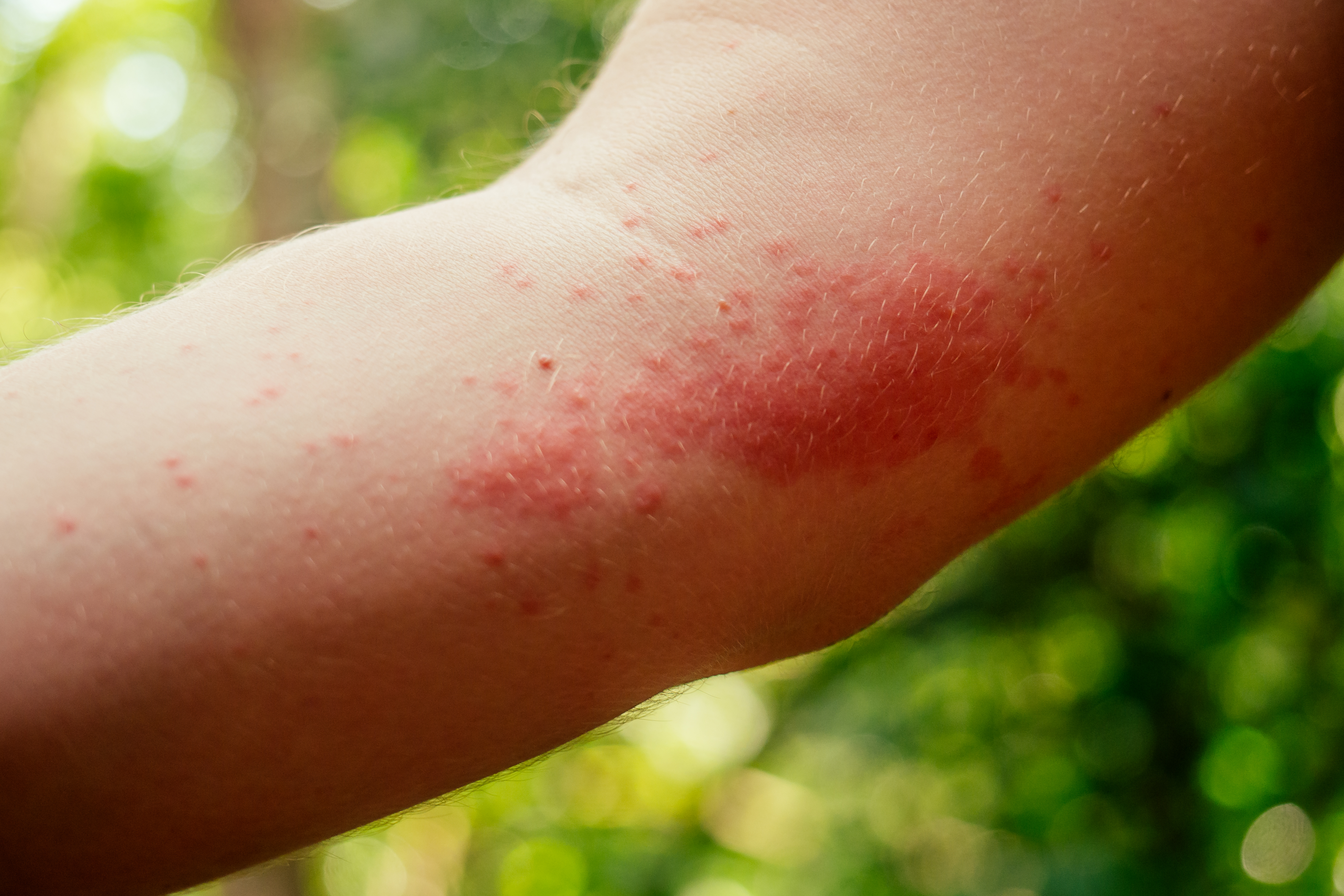 Combat Clay Soothing Skin Spray for allergic reactions relief