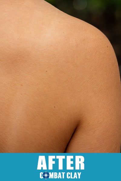 Clear healthy skin on shoulder after using Combat Clay Soothing Skin Spray