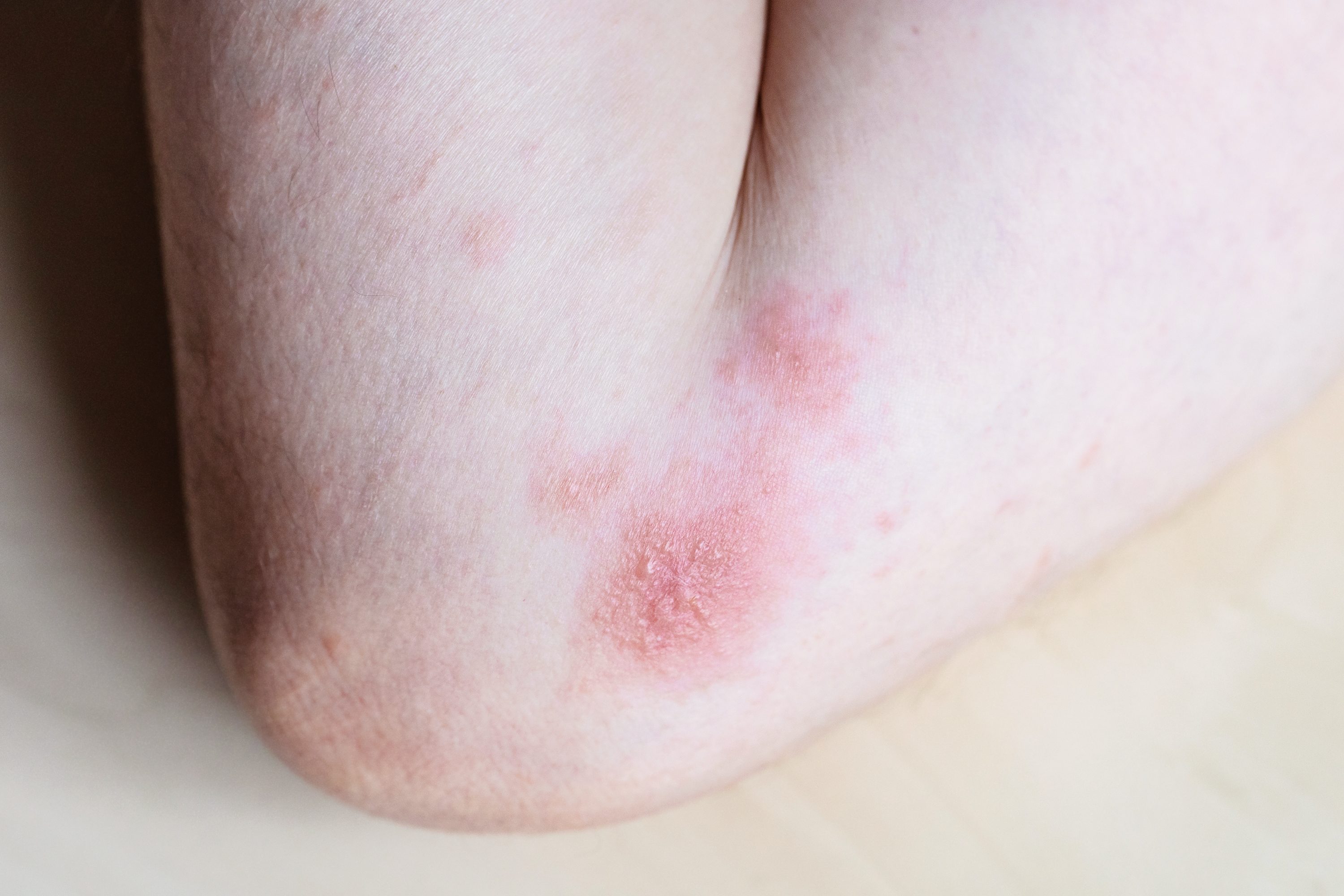 Combat Clay Soothing Skin Spray for eczema relief