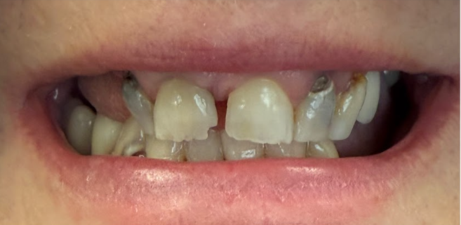 Restorative Care — patient's teeth before treatment at Cloud Family Dental