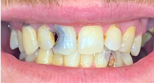 Smile Makeover — patient's teeth before treatment at Cloud Family Dental